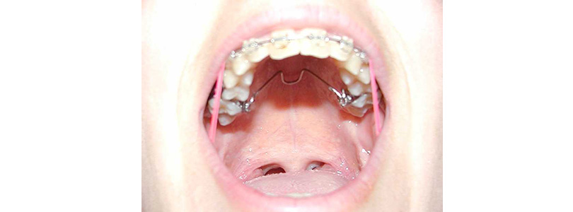 zel Ortodontik Apareyler TPA