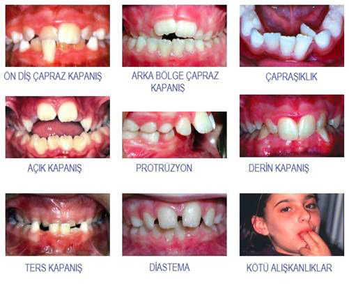 Çocuklarda Sık Görülen Ortodontik Problemler