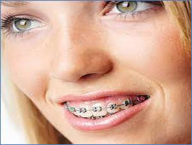 Klasik braketler ile ortodontik tedavi