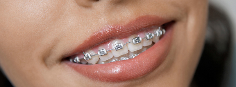 Ortodontide Braketler Nasıl Yapıştırılr?