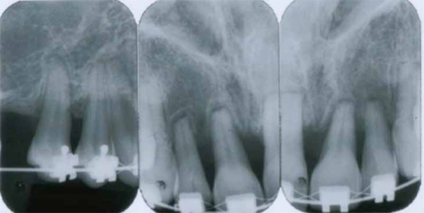 Ortodontik  Kuvvetin Di�in K�k Yap�s�na Etkileri