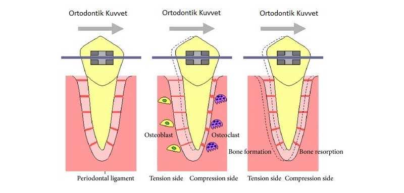 Ortodontik Tedavilerde Diler Nasl Hareket Eder