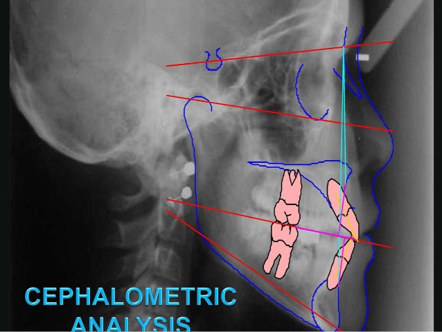 Sefalometrik Analiz